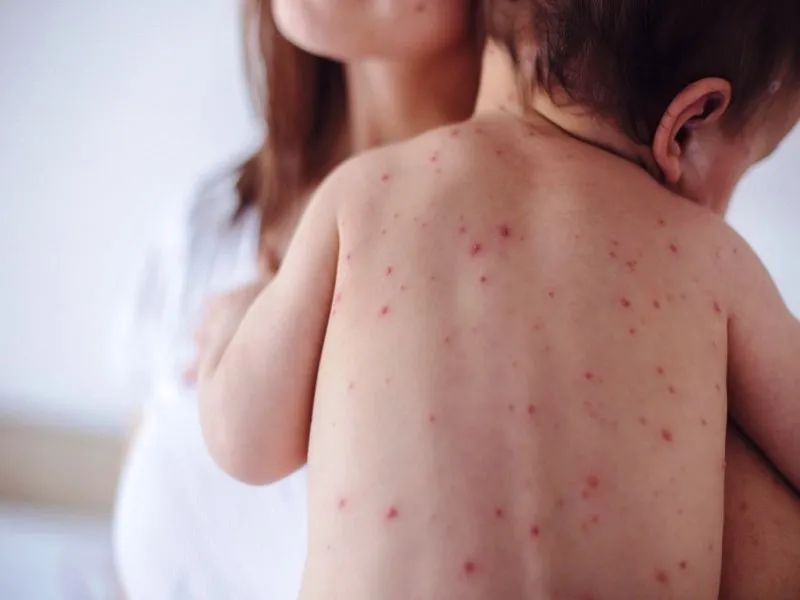 Surto de sarampo nos EUA preocupa médicos após aumento de casos em gestantes e recém-nascidos